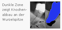 Darstellung der Reinigung eines Wurzelkanals mit modernen Instrumenten und Spüllösungen – präzises Vorgehen bei der Wurzelkanalbehandlung in der Zahnarztpraxis Farida Rauschning in Seelze.