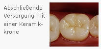 Wiederaufbau eines wurzelbehandelten Zahns mit Keramikkrone oder Inlay – ästhetische und funktionale Versorgung nach erfolgreicher Endodontie in Seelze bei Hannover.