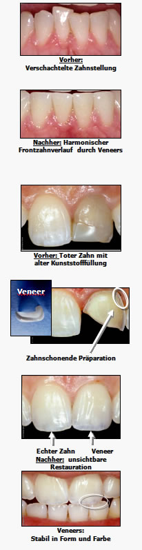 Veneers aus hochwertiger Keramik auf den Frontzähnen – Behandlung in der Zahnarztpraxis Farida Rauschning in Seelze bei Hannover. Die hauchdünnen Keramikschalen verbessern Zahnfarbe und Zahnform, gleichen Unregelmäßigkeiten aus und sorgen für ein natürlich harmonisches Erscheinungsbild der Schneidezähne.
